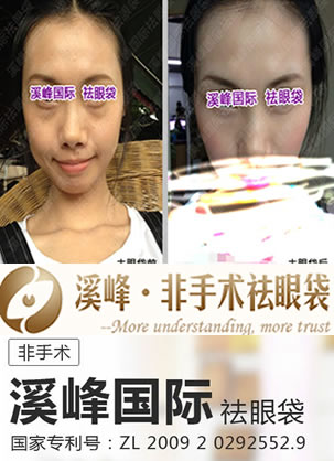 北京哪家医院去眼袋好?溪峰国际张志兵不开刀去眼袋真实案例
