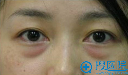 北京溪峰国际去眼袋前照片 北京溪峰国际去眼袋前照片