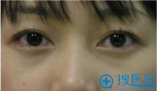 北京溪峰国际去眼袋案例照片 北京溪峰国际去眼袋案例照片