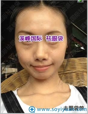 在北京溪峰国际祛眼袋前的照片 在北京溪峰国际祛眼袋前的照片