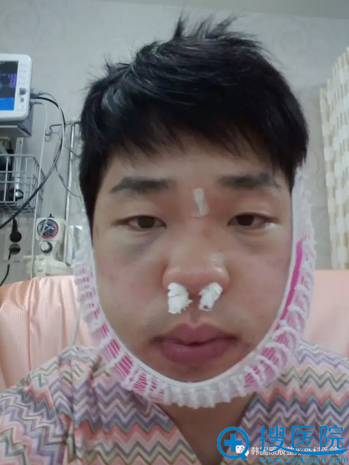 刚做完下颌角7天,很肿不好熬啊 刚做完下颌角7天,很肿不好熬啊