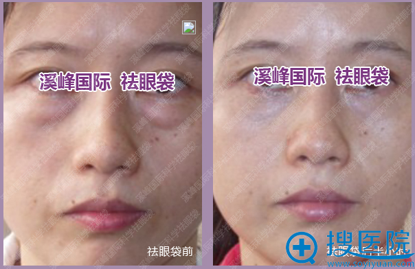 北京溪峰去眼袋案例对比图 北京溪峰去眼袋案例对比图