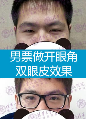 看我男票在北京玉泉医院尹卫东给做的开眼角和双眼皮效果怎么样