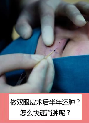 为什么我做双眼皮术后半年还肿?割双眼皮了怎么快速消肿呢?