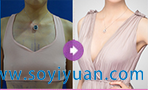 深圳美莱丰胸案例 深圳美莱丰胸案例