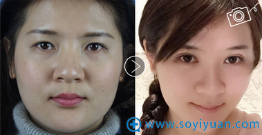 深圳美莱韩式双眼皮案例 深圳美莱韩式双眼皮案例