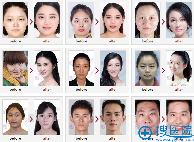 杭州维多利亚医疗美容医院双眼皮案例 杭州维多利亚医疗美容医院双眼皮案例
