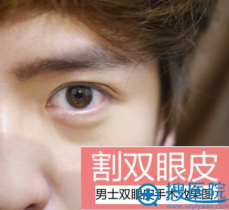 男士双眼皮手术效果图 男士双眼皮手术效果图