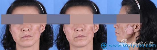 北京联合丽格王志军院长修复案例图 北京联合丽格王志军院长修复案例图
