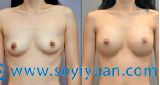 桂林美莱假体丰胸案例 桂林美莱假体丰胸案例