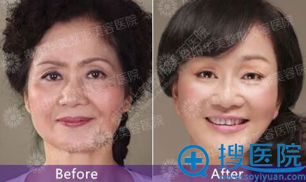 贵阳华美玻尿酸案例对比图 贵阳华美玻尿酸案例对比图