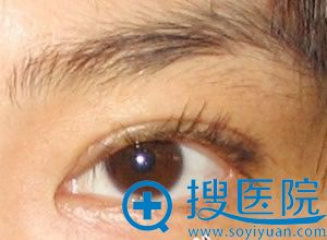 男生做双眼皮手术效果图 男生做双眼皮手术效果图