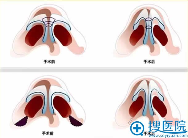 姜南讲解鼻部解剖在整形外科中的应用 姜南讲解鼻部解剖在整形外科中的应用