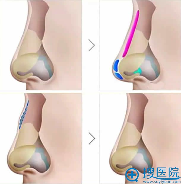 孟庆鹏演讲鼻部矫正整形手术 孟庆鹏演讲鼻部矫正整形手术