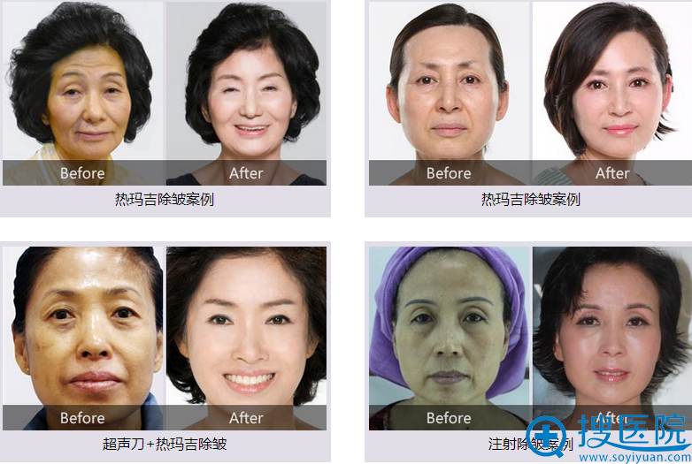 贵阳华美整形除皱案例 贵阳华美整形除皱案例