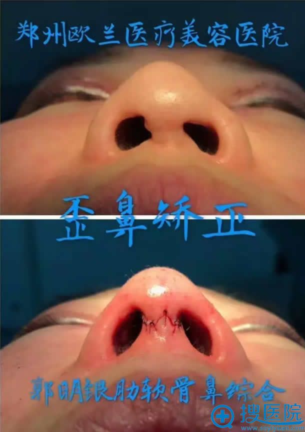 郭明银演讲歪鼻矫正手术案例 郭明银演讲歪鼻矫正手术案例