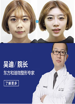 分享北京东方和谐整形医生吴迪为我做玻尿酸丰下巴效果图