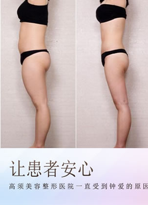 日本高须整形吸脂效果怎么样?高须克弥院长吸脂案例突显实力