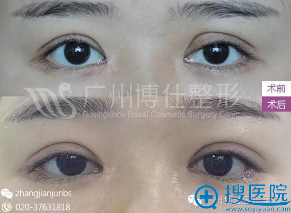 张建军博士为甜甜进行双眼皮修复后的效果对比照片 张建军博士为甜甜进行双眼皮修复后的效果对比照片