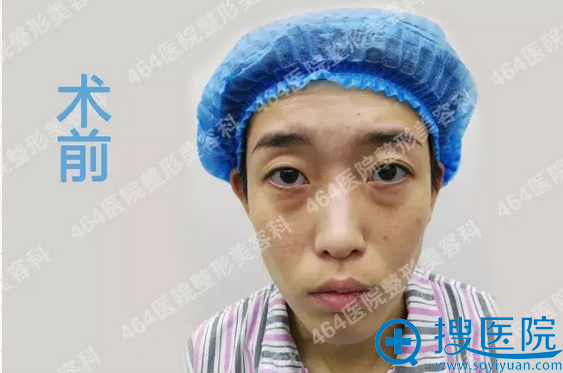 【经历】分享我在天津464整容医院做自体脂肪全脸填充1个月图片