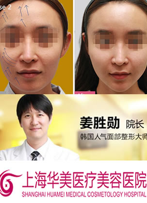 【经历】分享我在上海华美找姜胜勋院长做自体脂肪面部填充经历