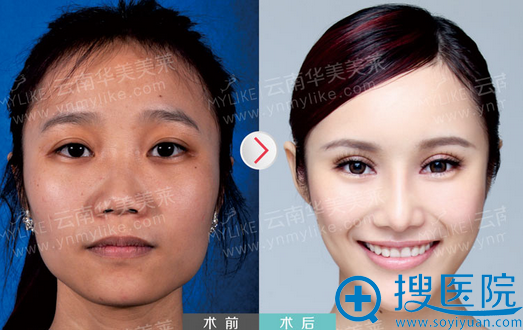 EYEMAX���Ǽ����ۡ�����˹���Ǽ��ǵ�����֬���沿�������Ч���Ա�