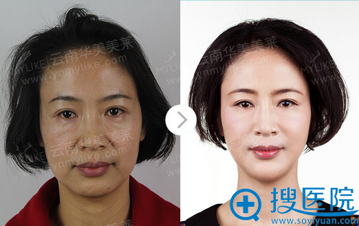 <!--<i data=20240710 data-id=5560></i>-->美莱逆龄童颜术术后效果对比 <!--<i data=20240710 data-id=5560></i>-->美莱逆龄童颜术术后效果对比