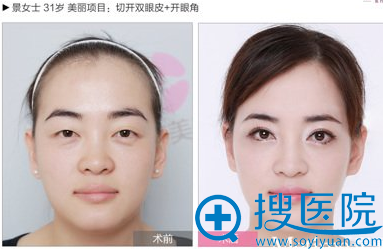 <!--<i data=20240710 data-id=7938></i>-->李海霞主任双眼皮案例 <!--<i data=20240710 data-id=7938></i>-->李海霞主任双眼皮案例