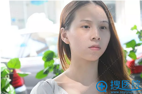 真实案例告诉你深圳美莱整形医院梁晓健隆鼻技术怎么样