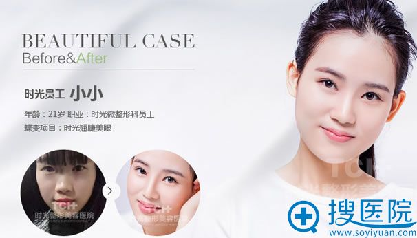 重庆时光员工体验翘睫美眼手术效果 重庆时光员工体验翘睫美眼手术效果