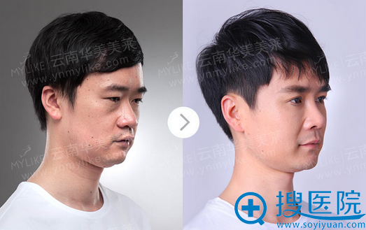 眼部综合整形、鼻部综合整形、烤瓷牙、瓷贴片术后效果对比 眼部综合整形、鼻部综合整形、烤瓷牙、瓷贴片术后效果对比