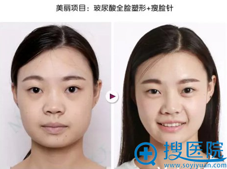 <!--<i data=20240710 data-id=7938></i>-->闫琨玻尿酸+注射案例 <!--<i data=20240710 data-id=7938></i>-->闫琨玻尿酸+注射案例