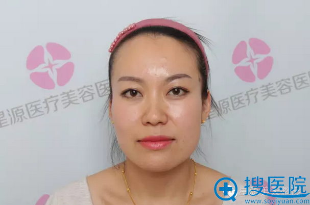 【案例】看我在石家庄星源美天医院做全面部蛋白线提升10天效果