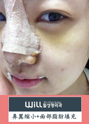 在韩国will找魏亨坤做的鼻翼缩小手术+面部填充效果 花费3万RMB