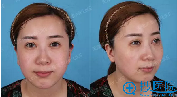 【经历】刚去天津美莱花35000元做完面部线雕1周 看我年轻几岁