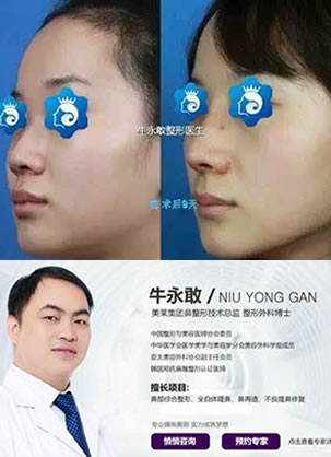 分享我在新疆华美整形找王超杰医生做鼻综合隆鼻的整形经历