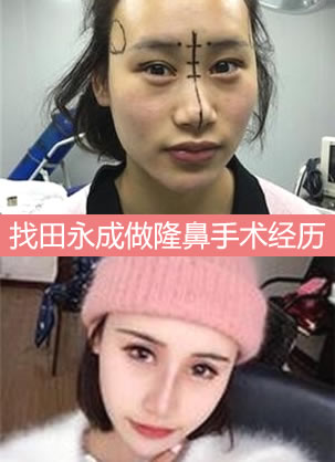 找北京田永成隆鼻手术一个月啦 成功摆脱塌鼻子做个萌妹子
