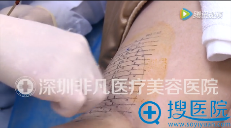 治疗前为治疗区域做清洁、消毒处理 治疗前为治疗区域做清洁、消毒处理