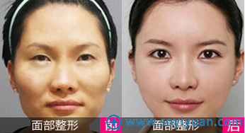 <!--<i data=20240710 data-id=16801></i>--> 亲诊项目:面部整形 <!--<i data=20240710 data-id=16801></i>--> 亲诊项目:面部整形