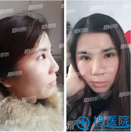 双眼皮+隆鼻术后第7天 双眼皮+隆鼻术后第7天