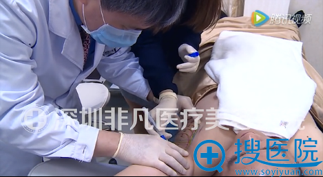 治疗前选择测量模版,定位腋下治疗区域 治疗前选择测量模版,定位腋下治疗区域