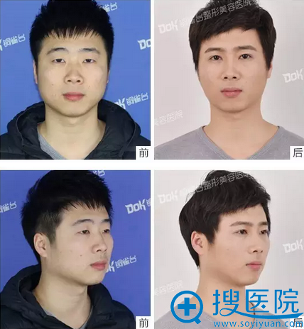 <!--<i data=20240710 data-id=16801></i>-->双眼皮术后正面、侧面效果对比 <!--<i data=20240710 data-id=16801></i>-->双眼皮术后正面、侧面效果对比