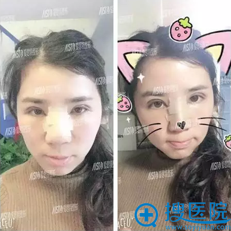 术后天的样子 术后天的样子