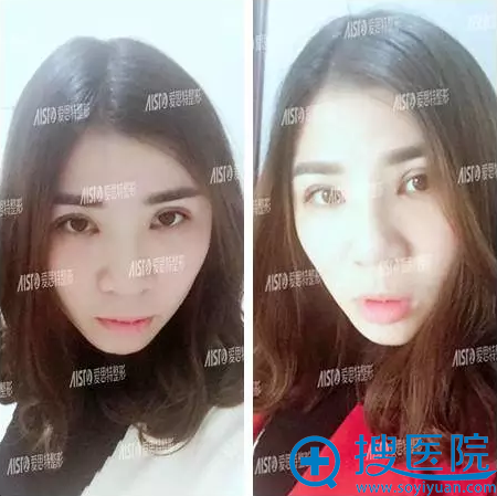 双眼皮+隆鼻术后第15天恢复照,超自然 双眼皮+隆鼻术后第15天恢复照,超自然