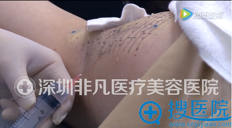 微波祛腋臭前注射局部麻醉剂 微波祛腋臭前注射局部麻醉剂