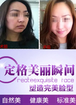 【经历】在韩国原辰整形做V-line提升术恢复过程 让我年轻10岁