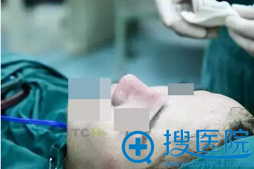 取出骨粉后,吕敏院长鼻整形修复手术后即刻效果 取出骨粉后,吕敏院长鼻整形修复手术后即刻效果