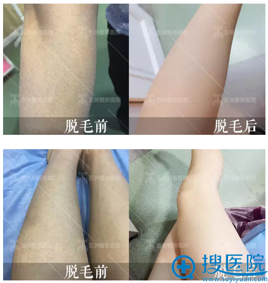 全身激光脱毛后高清对比图 全身激光脱毛后高清对比图