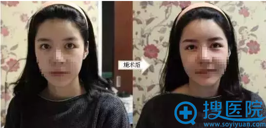 韩式半纹眉前后对比图 韩式半纹眉前后对比图