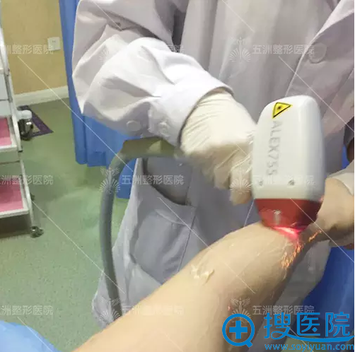 手臂激光脱毛进行中 手臂激光脱毛进行中